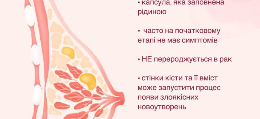Як позбутися кісти в грудях: народні методи лікування