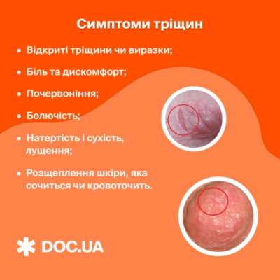 Народні методи від тріщин на сосках: дієві поради для мам