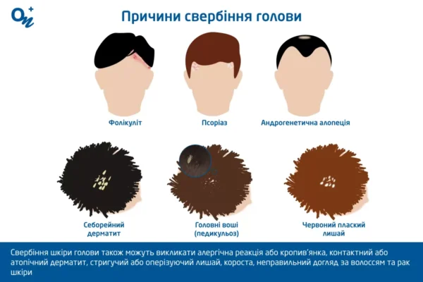 Як заспокоїти шкіру голови в домашніх умовах: практичні поради