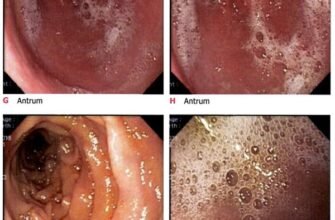 Головні успіхи в лікуванні ГЕРХ: історії людей, які подолали хворобу