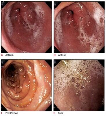 Головні успіхи в лікуванні ГЕРХ: історії людей, які подолали хворобу
