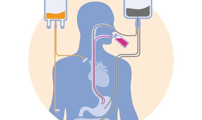 Ентеральне харчування: важливість та переваги підтримки організму