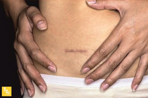 Ефективні методи позбавлення від спайок в домашніх умовах: покроковий гайд