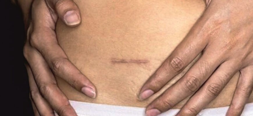 Ефективні методи позбавлення від спайок в домашніх умовах: покроковий гайд Ефективні методи позбавлення від спайок в домашніх умовах: покроковий гайд