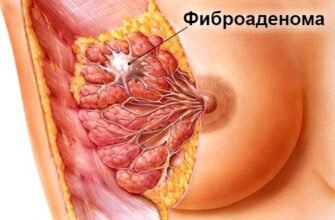 Хто вилікував фіброаденому: форум для обговорення досвіду