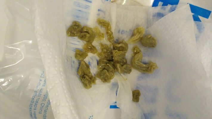 Як виглядають аскариди в калі: ознаки та діагностика паразитів