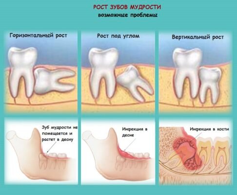 Ефективні методи видалення зубів мудрості: поради та рекомендації