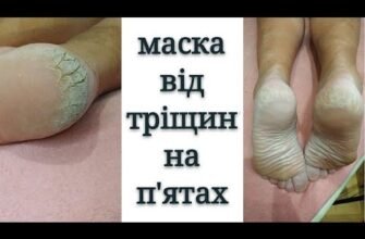 Тріскають п’яти: ефективні народні методи лікування та догляду