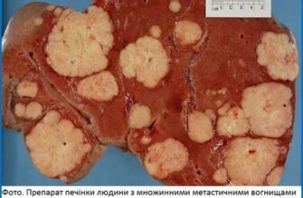 Як помирають від раку підшлункової: процес та симптоми на останніх стадіях