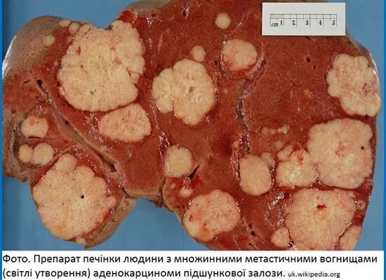 Як помирають від раку підшлункової: процес та симптоми на останніх стадіях