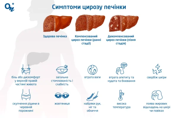 Хто вилікувався від цирозу печінки? Досвід людей та реальні історії