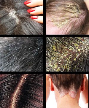 Як швидко позбутися лупи в домашніх умовах за 1 день: поради експертів Як швидко позбутися лупи в домашніх умовах за 1 день: поради експертів