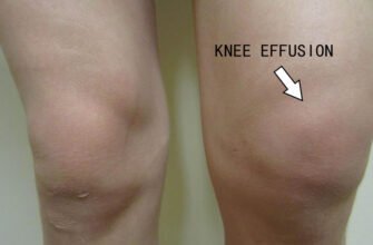 Ефективні народні методи для лікування рідини в коліні: поради та рецепти