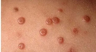 Ефективні народні методи лікування контагіозного молюска вдома