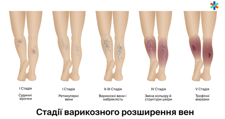 Хто лікує варикоз: знайдіть фахівця для ефективного лікування варикозу
