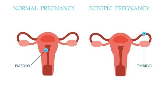 Позаматкова вагітність: як самостійно визначити вдома – поради лікарів Позаматкова вагітність: як самостійно визначити вдома – поради лікарів