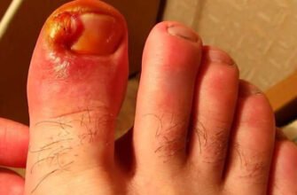 Нариває палець на нозі: ефективні народні методи лікування