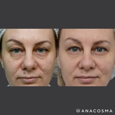 Ефективні народні методи проти чорних кругів під очима: поради та рецепти