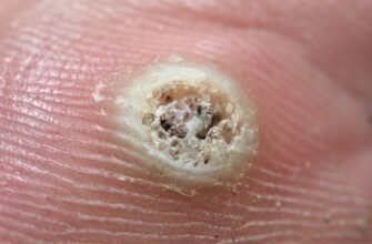 Як виглядає бородавка: зовнішні ознаки та методи визначення