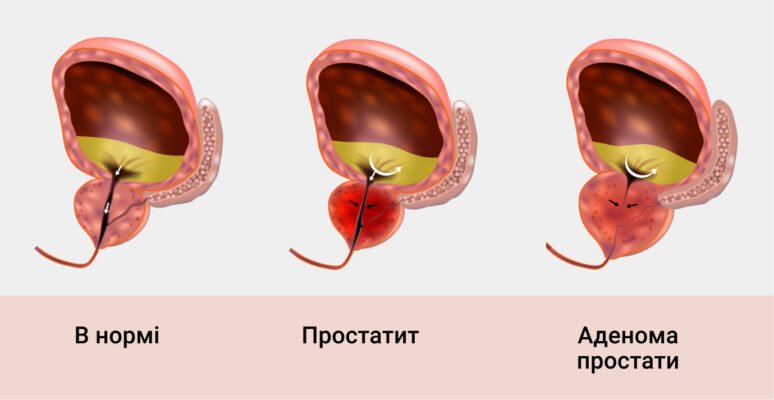 Як я позбувся аденоми простати: мій досвід та поради