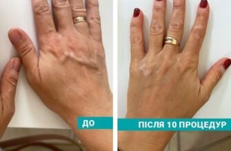 Сучасні методи лікування вітіліго: ефективні підходи та новинки 2023