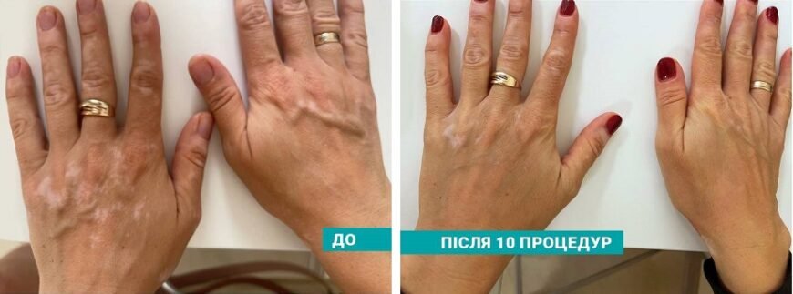 Сучасні методи лікування вітіліго: ефективні підходи та новинки 2023