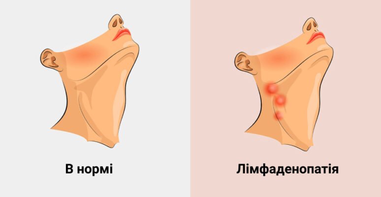Хто лікує лімфовузли: до якого спеціаліста звертатися?
