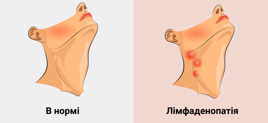 Хто лікує лімфовузли: до якого спеціаліста звертатися?