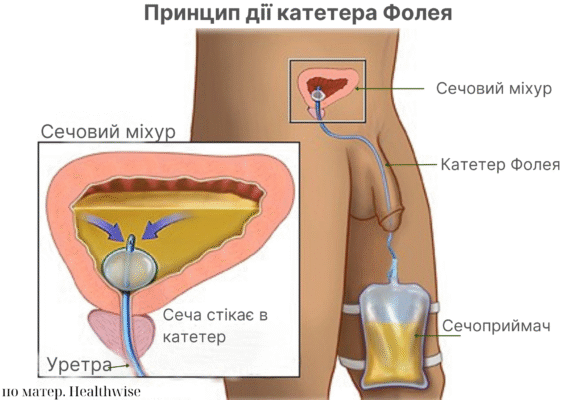 Сечовий катетер: види, установка та догляд для здоров’я сечової системи