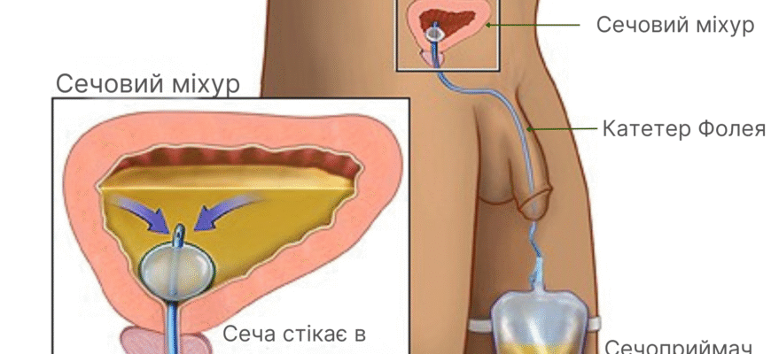 Сечовий катетер: види, установка та догляд для здоров’я сечової системи