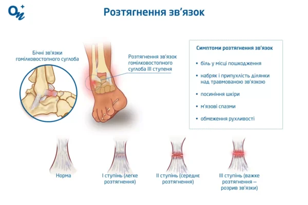 Народні методи лікування розтягнення зв’язок: дієві рецепти та поради