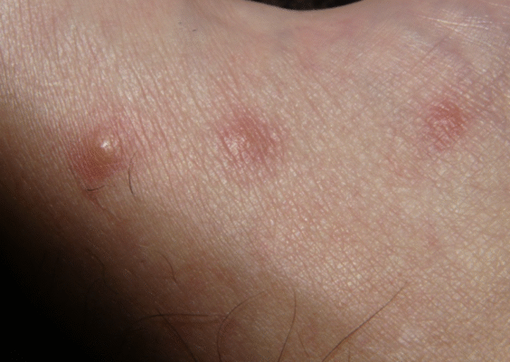 Як виглядає укус пилового кліща: ознаки та симптоми реакції шкіри