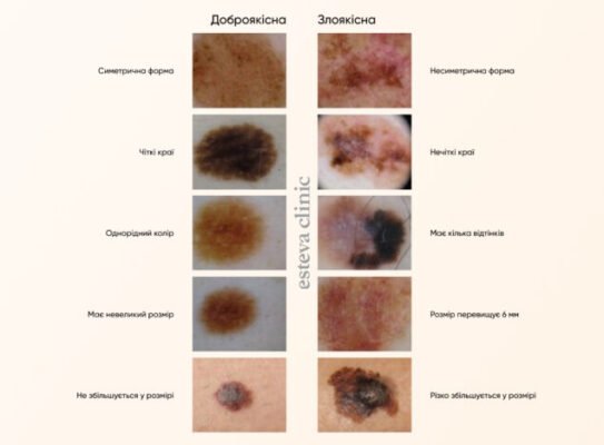 Як виглядає злоякісна родимка: ознаки та симптоми меланоми
