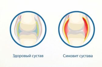 Ефективні народні методи лікування синовіту: натуральні засоби та поради