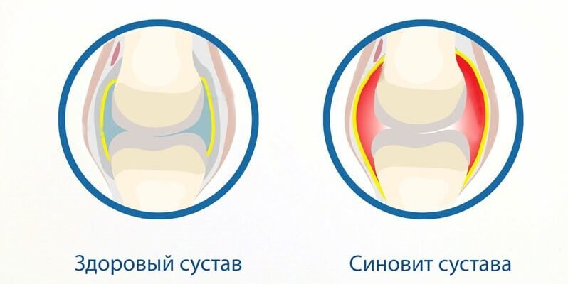 Ефективні народні методи лікування синовіту: натуральні засоби та поради