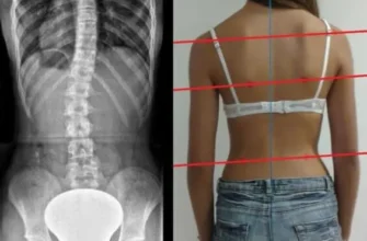 Хто лікує сколіоз: пошук фахівця для ефективного лікування