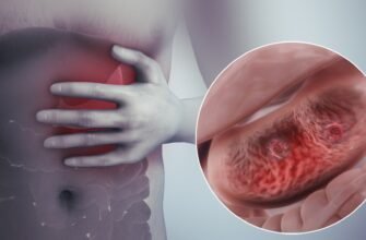 Еритематозна гастропатія: ефективні народні методи лікування