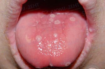 Ефективні народні методи лікування прища на язиці: перевірені засоби