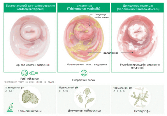 Як лікувати неприємний запах з вагіни в домашніх умовах: поради