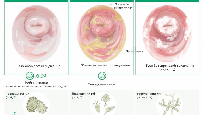Як лікувати неприємний запах з вагіни в домашніх умовах: поради