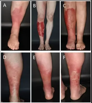 Сучасні методи лікування бешихи: ефективні рішення для здоров’я