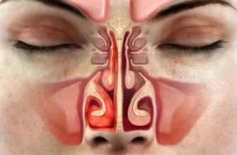 Ефективні народні методи лікування закладеного носа без ліків