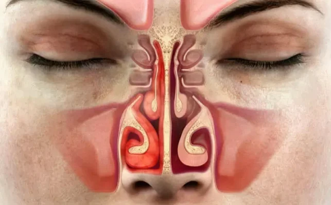 Ефективні народні методи лікування закладеного носа без ліків Ефективні народні методи лікування закладеного носа без ліків