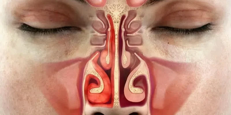 Ефективні народні методи лікування закладеного носа без ліків