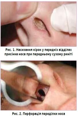 Сухість в носі: ефективні народні методи лікування для полегшення