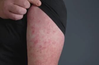 Як зняти рожу в домашніх умовах: ефективні методи та поради