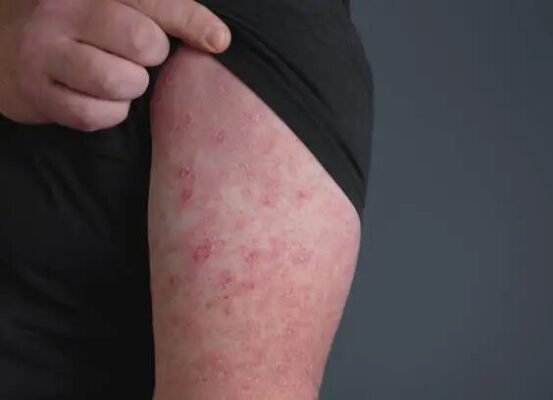 Як зняти рожу в домашніх умовах: ефективні методи та поради