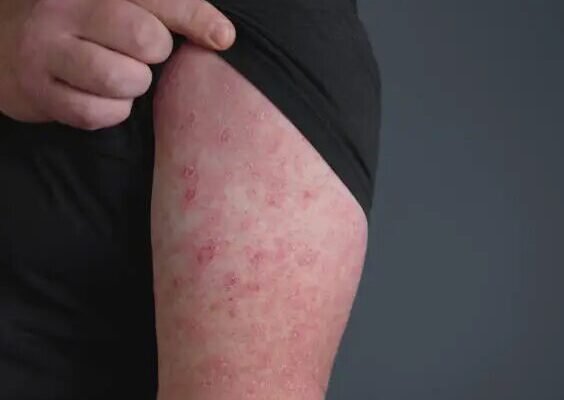 Як зняти рожу в домашніх умовах: ефективні методи та поради