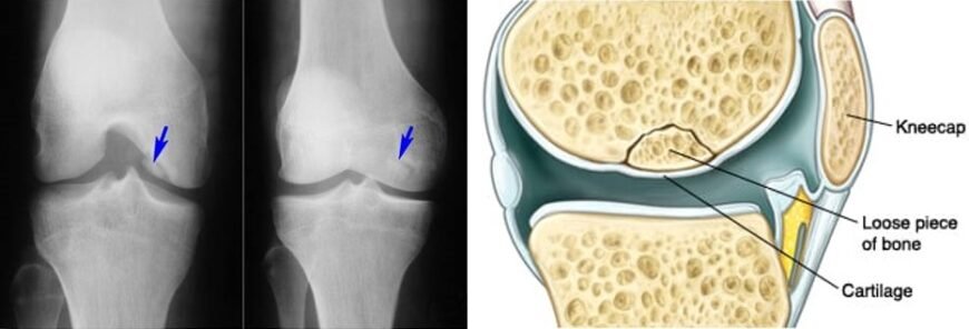 Хвороба Кеніга: як впливає на інвалідність і які є рішення?