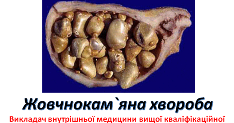 Жовчнокам’яна хвороба: причини, симптоми та методи лікування